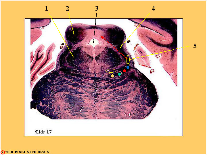  Slide 17 - the rostral Pons/Midbrain 