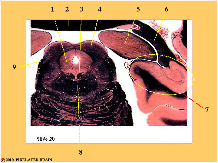  Slide 20 - the rostral Pons/Midbrain 