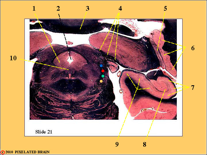  Slide 21 - Midbrain/Diencephalon 